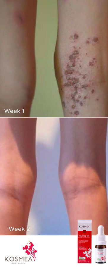 Dermatitis Before and After